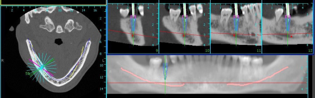 Implant_Software_CT